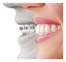 Invisalign