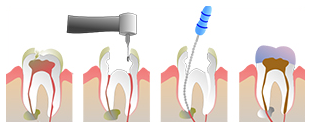 Root Canal Treatment